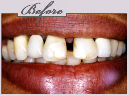 new york porcelain veneers